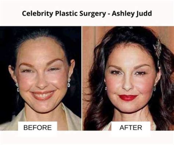 Ashley Judd Plastic Surgery Before and After