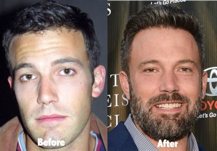Ben Affleck Plastic Surgery Before and After