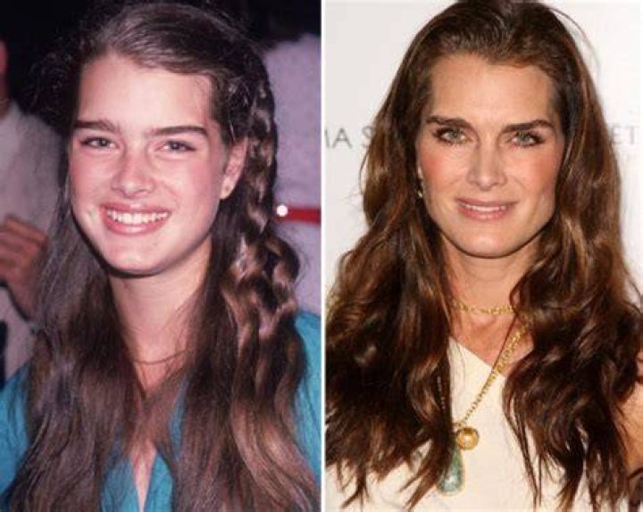 Brooke Shields Plastic Surgery Before and After