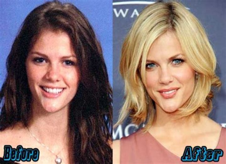 Brooklyn Decker Plastic Surgery Before and After