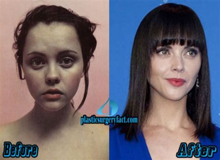Christina Ricci Plastic Surgery Before and After