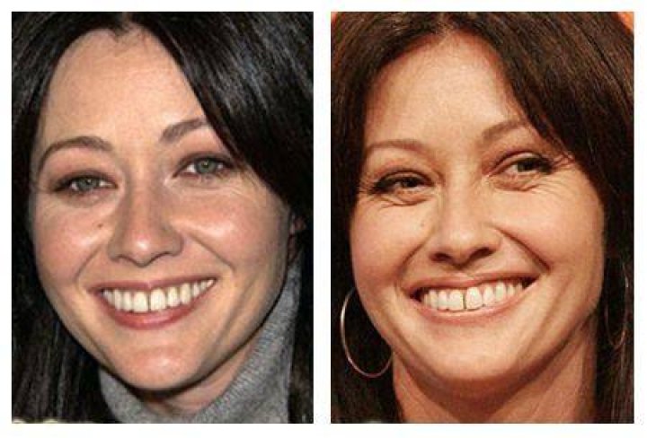 Shannen Doherty Plastic Surgery Before and After